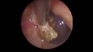 825  Cholesteatoma Ear Wax Removal [upl. by Nitnilc751]