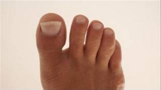 How To Remedy Yellow Toenails [upl. by Ytsur]