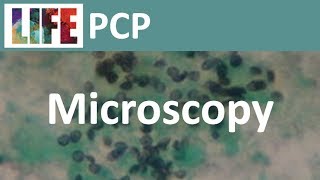 Pneumocystis microscopy [upl. by Earesed]