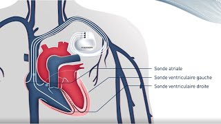 Traitement par resynchronisation cardiaque CRT [upl. by Yla]