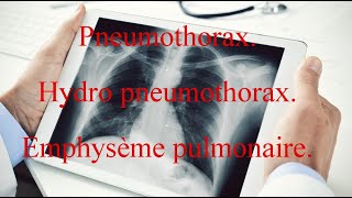 Pneumothorax  Hydro pneumothorax  Emphysème pulmonaire [upl. by Clare]