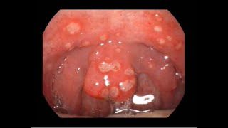 Acute Ulcerative Pharyngitis Causing Severe Sorethroat [upl. by Ydaj]