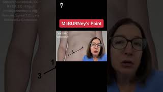 McBurneys point MedicalSurgical SHORT [upl. by Gillespie]