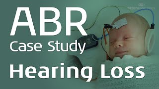 ABR Case Study Sensorineural Hearing Loss [upl. by Dlonra]