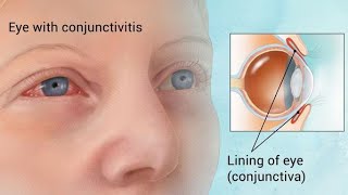 Conjunctivitis  Ophthalmology Videos [upl. by Morna]