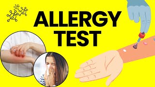 What Is An Allergy Test Procedure Side Effects Precautions amp Reports [upl. by Baniez523]