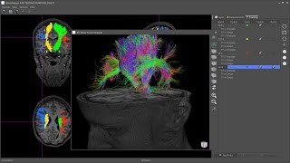 BrainMagix 21 Constrained spherical deconvolutionbased tractography [upl. by Anelehs]