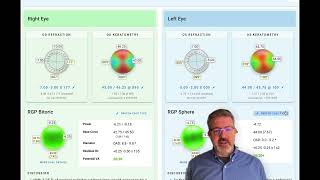 EyeDocks New Contact Lens Calculator Abridged Video [upl. by Mcclees]