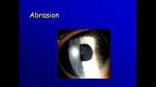 Cornea  2a Corneal ulcer Clinical picture [upl. by Waldack]