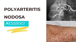 Poly Arteritis Nodosa [upl. by Jeaz]