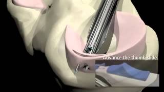 Arthroscopic Meniscus Repair [upl. by Mosra]