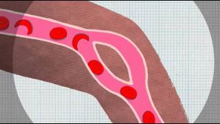 Sickle Cell Anaemia Explained [upl. by Cynera746]