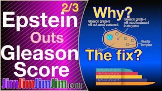 Epstein outs Gleason score 23 Why The fix [upl. by Elfrieda]