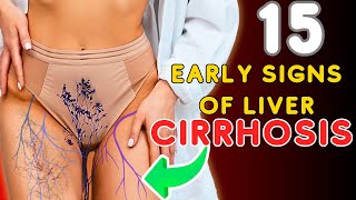 15 Early Signs of Liver CIRRHOSIS  Causes of Liver Cirhosis  LIVER is DYING [upl. by Doy]