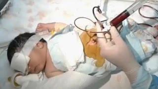 Blood Exchange Transfusion  Neonatal Jaundice [upl. by Kciredec706]