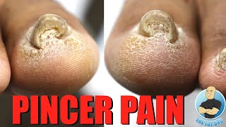 PAINFUL PINCER TOENAILS GETTING REMOVED [upl. by Aikem628]