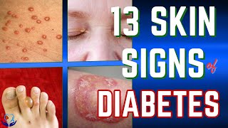 Discover 13 Skin Signs of Diabetes Now [upl. by Atsyrt]