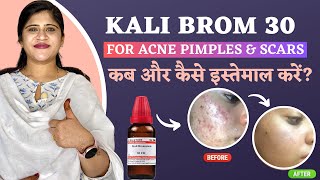 Magical Remedy For Acne Pimples and Scars  kali Brom 30  कब और कैसे इस्तेमाल करें  Dr Arwa Bohra [upl. by Uttica]