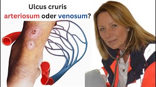 Was ist der Unterschied zwischen einem ulcus cruris arteriosum und venosum [upl. by Olgnaed381]