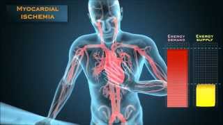 Understanding the energetic mechanisms that cause angina pectoris [upl. by Sartin]