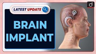 Brain Implant  Epilepsy  Latest Update  Drishti IAS English [upl. by Dimmick721]