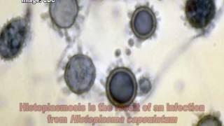 Histoplasma capsulatum amp Histoplasmosis [upl. by Carlyn]