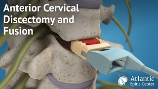 Anterior Cervical Discectomy and Fusion [upl. by Mian]