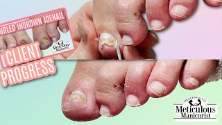 PINCER Toenail Transformation Journey  3rd Visit [upl. by Annerol270]