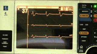 Third Degree Heart Block Complete Block [upl. by Beisel]