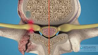 What is Cervical Lateral Stenosis AtlanticSpineCenter [upl. by Boyden]