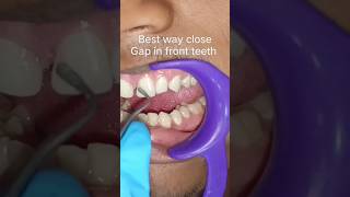 Best treatment to close gap in front teeth dental dentalcare trending youtube youtubeshorts [upl. by Uwton]