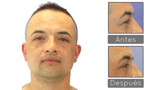 Blefaroplastia Superior Antes y Después  Experiencia Adrián [upl. by Crescint]