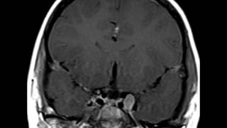 Neurofibromatosis Type 2 [upl. by Okihsoy]