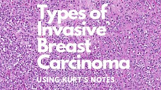 Types of Invasive Breast Carcinoma Kurt’s Notes pathagonia [upl. by Assele70]