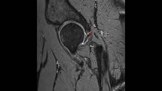 Tear of the posterior hip labrum [upl. by Annitsirhc]