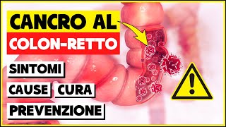 TUMORE AL COLON Sintomi Cause Cura e Prevenzione  Quello che devi sapere sul cancro del colon [upl. by German]