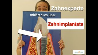 Zahnimplantaten wichtige Fragen kurz und knackig erklärtTeil 1 [upl. by Ainalem]