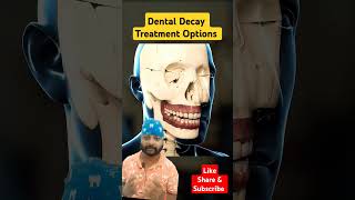 Dental Cavity treatment Optionsyt ytshorts shorts dental ytshortsindia teethdentalcavity [upl. by Brenn224]