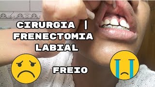 vlog  Cirurgia  Frenectomia Labial FREIO Doeu [upl. by Pietro]