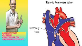 PULMPNARY STENOSIS VALVE BY DRSUMIT TYAGISUMITMEDICALDISPENSARY1 [upl. by Einnalem]