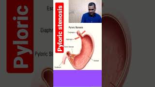 pyloric stenosis to watch full video click on link given in comments section [upl. by Nollaf312]