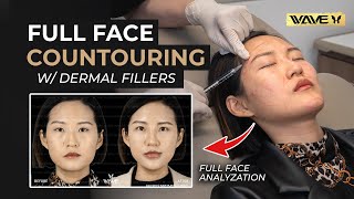 Facial Transformation with Fillers Adding Facial Contour without Surgery [upl. by Tsirhc]