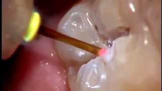 Tratamiento de caries sin dolor y sin anestesia Láser dental [upl. by Evanne]