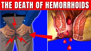 How to GET RID OF Hemorrhoids FOREVER Hemorrhoids Treatment [upl. by Young]