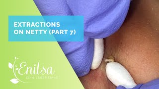 Extracting Blackheads on Netty  Seventh Treatment [upl. by Neahs]