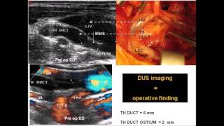 Thoracic duct end obstruction  By Claude Franceschi [upl. by Kinimod352]