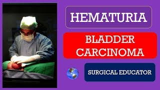 BLADDER CARCINOMA How To DIAGNOSE amp TREAT  HEMATURIA [upl. by Hyozo]