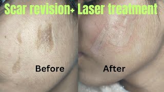 Result of scar revision surgery laser treatment Scar revision surgery in Ranchi [upl. by Aisetal]