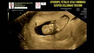 Hydrops Fetalis 11 weeks [upl. by Aivatan]