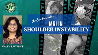 MRI IN SHOULDER INSTABILITY  MALINI LAWANDE  Hill Sachs  Bankart  Labral Tear  ALPSA  HAGL [upl. by Assyle]